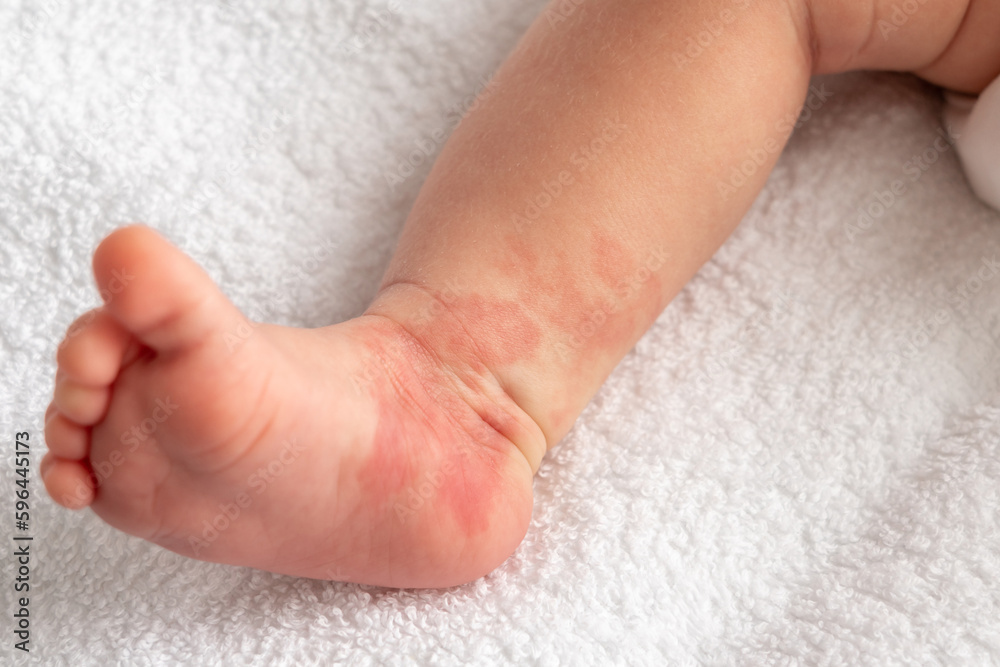 Hemangioma red birthmark on the leg of newborn baby Hemangioma red birthmark on the leg of newborn baby