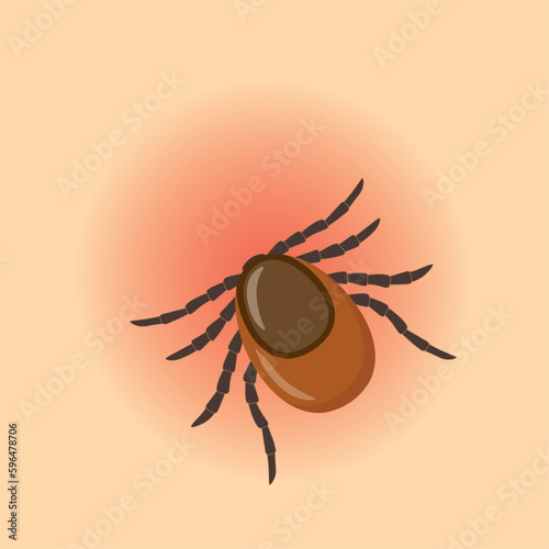 tick sticking in human skin, risk of infection of lyme and  tick-borne disease -vector illustration