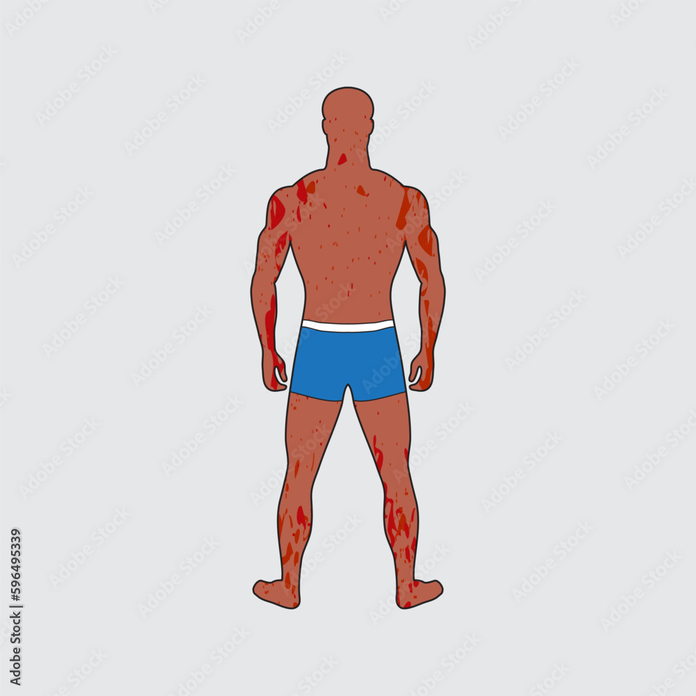 Fototapeta premium Painful dermatous skin rash on tanned adult male