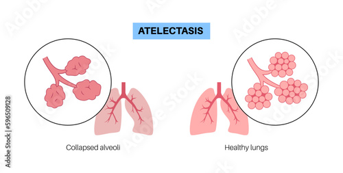 Atelectasis medical poster photo