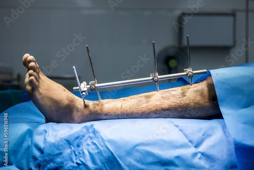 The external fixator in orthopedic patient after car accident.External fixation with blur background inside operating room.Blue drape.Fracture left leg after trauma.Severe injury with damage control. photo