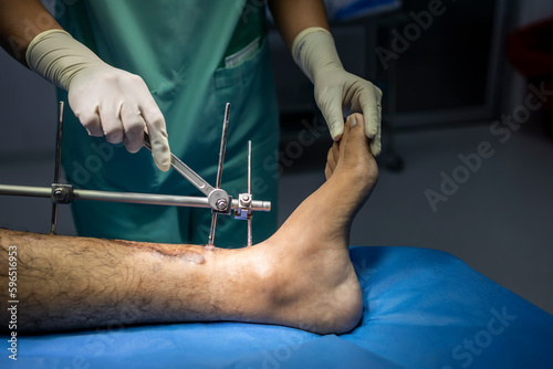 Hand of doctor or surgeon using medical wrench tool to tighten external fixator in orthopedic patient after car accident.External fixation with white blur background inside operating room.Blue drape. photo
