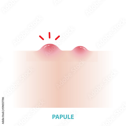 Papule acne vector on white background. Formation of inflammatory acne, papule, small, raised, solid pimple or swelling, forming on the skin and  inflamed. Flat design vector acne illustration.