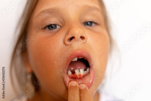 Fearless, brave little girl pull off lip, show toothless mouth and fresh wound bleeding after tooth extraction on white background. Orthodontic practice and dental work. Dental care. Copy space
