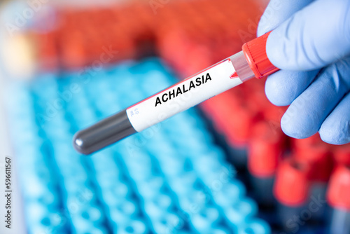 Achalasia. Achalasia disease blood test in doctor hand photo