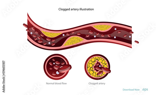 Cholesterol deposits (plaques) in the heart arteries and inflammation are usually the cause of coronary artery disease. Artery blockage vector illustrations.