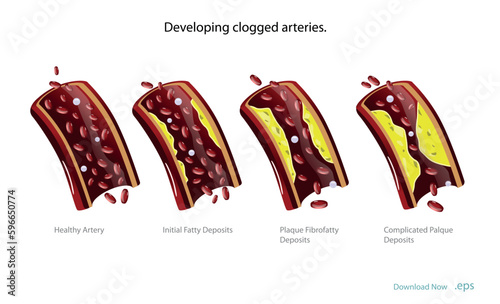 Cholesterol deposits (plaques) in the heart arteries and inflammation are usually the cause of coronary artery disease. Artery blockage vector illustrations.