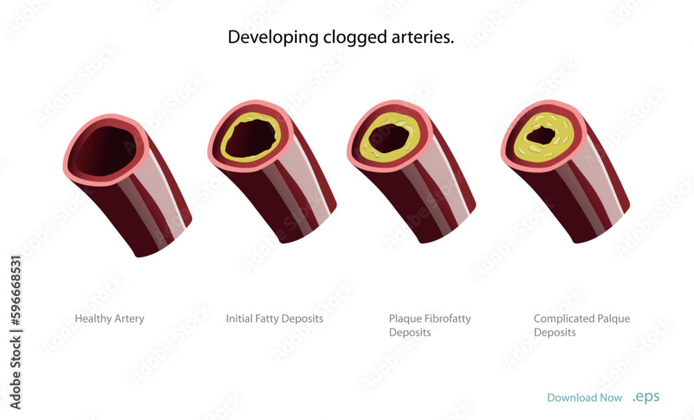 Cholesterol deposits (plaques) in the heart arteries and inflammation ...