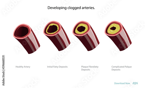 Cholesterol deposits (plaques) in the heart arteries and inflammation are usually the cause of coronary artery disease. Artery blockage vector illustrations.