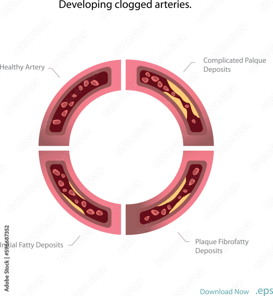 Cholesterol deposits (plaques) in the heart arteries and inflammation are usually the cause of