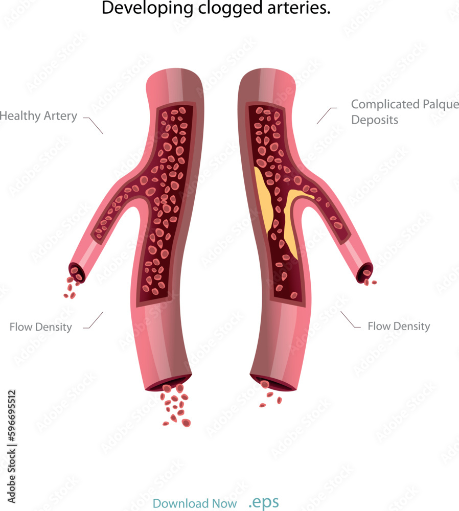 Cholesterol deposits (plaques) in the heart arteries and inflammation are usually the cause of