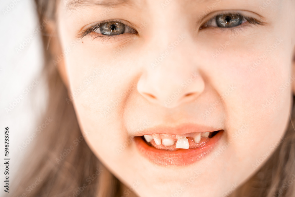 Charming smiling little girl kid with opened mouth shows staggering loose falling out first baby milk front tooth. Preschooler teeth changing. Healthy dental hygiene. Lost tooth. Dentist treatment Charming smiling little girl kid with opened mouth shows staggering loose falling out first baby milk front tooth. Preschooler teeth changing. Healthy dental hygiene. Lost tooth. Dentist treatment