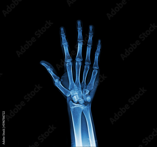 X-ray hand AP view normal