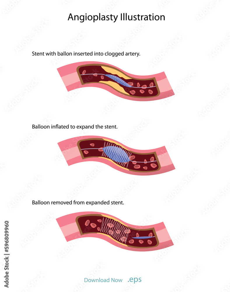 Cholesterol deposits (plaques) in the heart arteries and inflammation are usually the cause of coronary artery disease. Artery blockage vector illustrations. - obrazy, fototapety, plakaty 