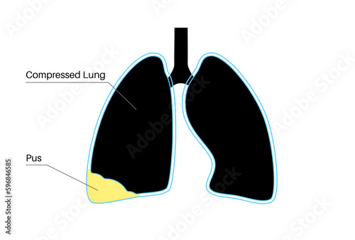 Pyothorax pleural empyema