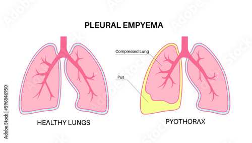 Pyothorax pleural empyema photo