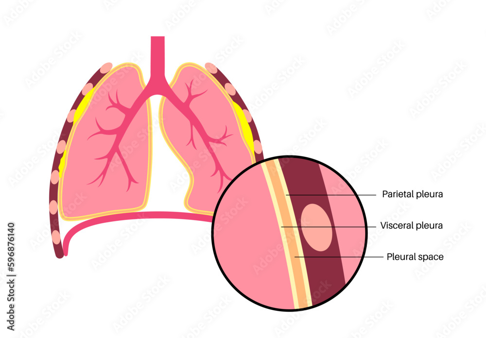 Pleural plaque poster Stock Vector Adobe Stock