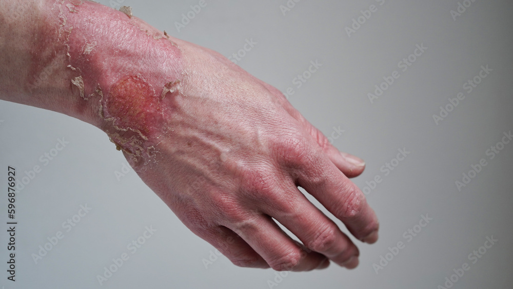 Closeup of a woman's hand with a burst blister from a boiled water