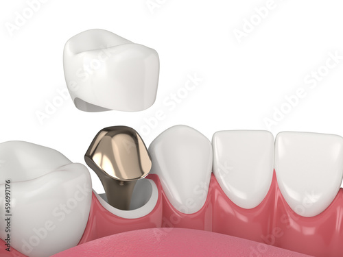 3d render of lower jaw with cast post and core tooth restoration