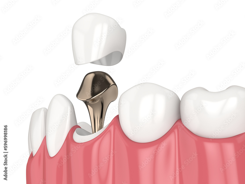 3d render of lower jaw with cast post and core tooth restoration 3d render of lower jaw with cast post and core tooth restoration