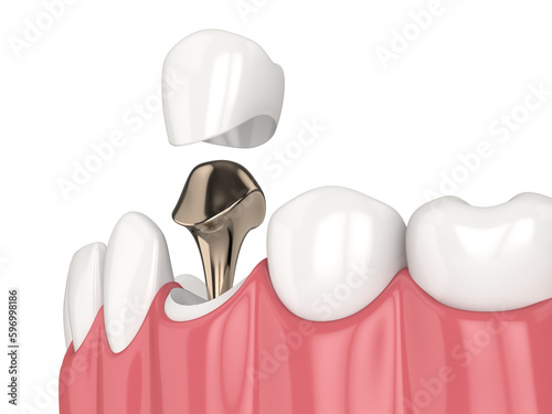3d render of lower jaw with cast post and core tooth restoration photo