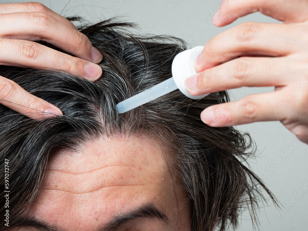 Fototapeta premium 頭皮に育毛剤を塗る男性 スカルプケア