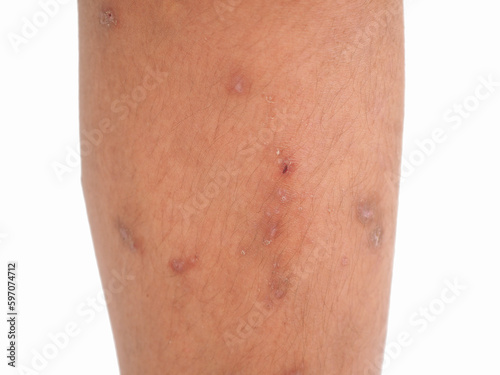 Boy's legs with many red spot and scar from insect bites. Closeup photo, blurred.