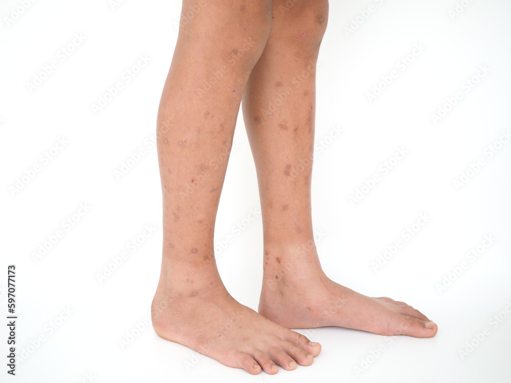 Boy's legs with many red spot and scar from insect bites. Closeup photo, blurred. Boy's legs with many red spot and scar from insect bites. Closeup photo, blurred.