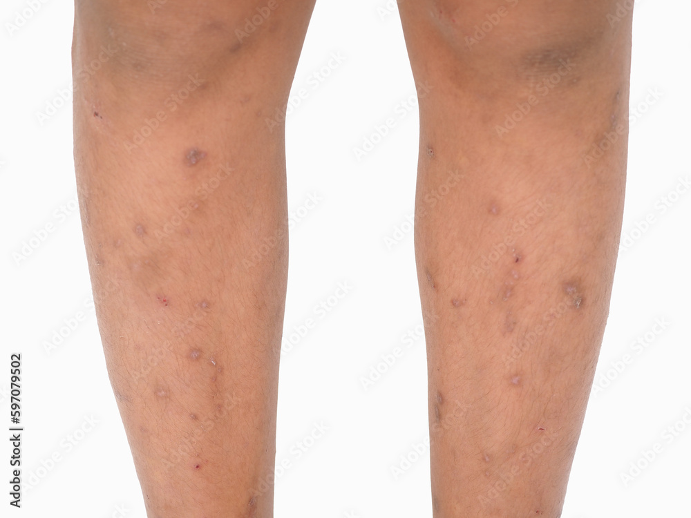 Asian boy has allergies with mosquitoes bite. Many mosquito bites hurt and scars on the legs. Closeup photo, blurred. Asian boy has allergies with mosquitoes bite. Many mosquito bites hurt and scars on the legs. Closeup photo, blurred.