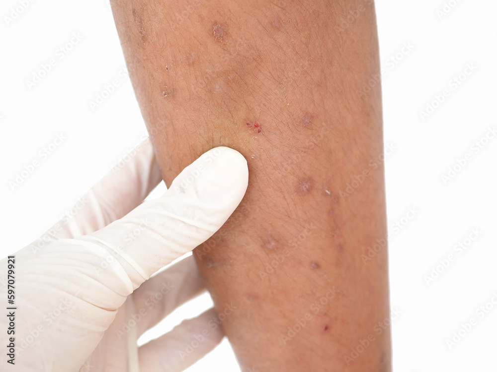 Asian boy has allergies with mosquitoes bite. Many mosquito bites hurt