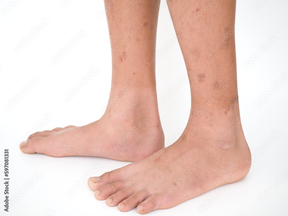 Boy's legs with many red spot and scar from insect bites. Closeup photo, blurred. Boy's legs with many red spot and scar from insect bites. Closeup photo, blurred.