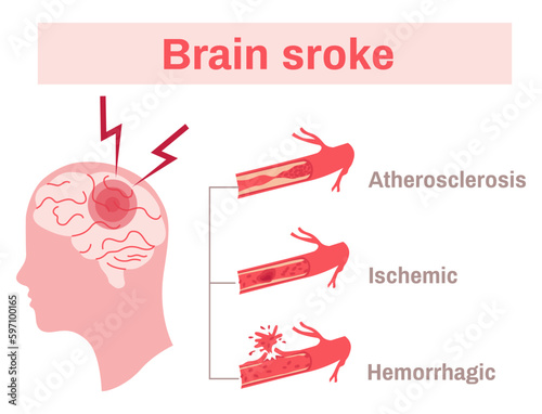 Stroke Flat Infographics