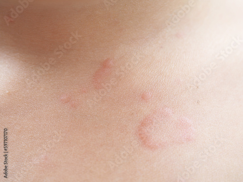 Asian kid's chest rash is caused by urticaria, food allergies, insect bites. health concept. Closeup photo, blurred. photo