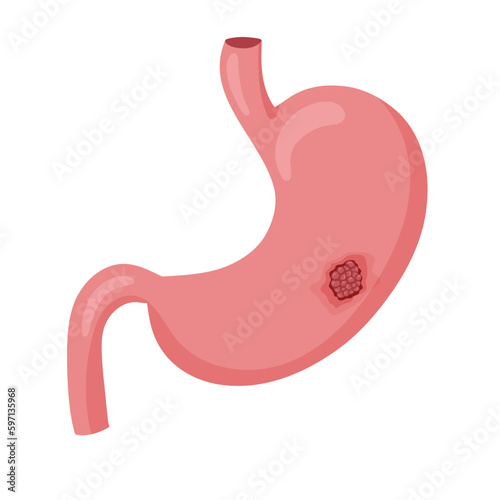 Stomach cancer. Malignant cancerous tumor. Anatomical vector illustration isolated white background cartoon style