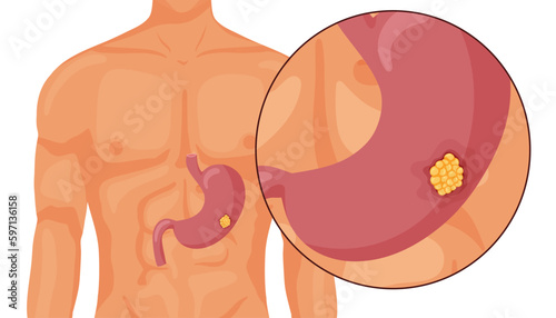 Stomach cancer. Malignant cancerous tumor. Anatomical vector illustration isolated white background cartoon style