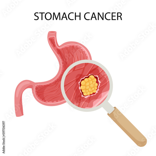  Stomach cancer. Malignant cancerous tumor enlarged under magnifying glass. Anatomical vector illustration isolated white background cartoon style