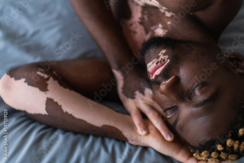 Top view of shirtless african american man with vitiligo sleeping on bed.
