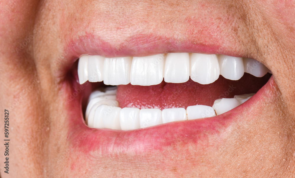 Obraz premium emax ceramic bridge on implants