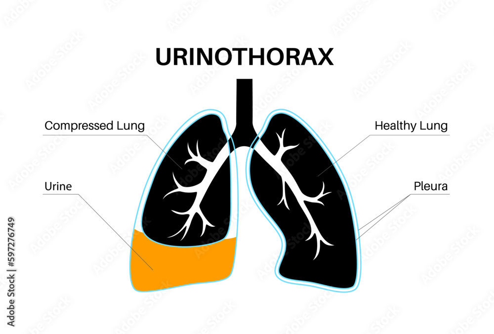 Urinothorax anatomical poster Urinothorax anatomical poster