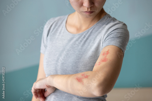 Painful shingles in woman photo