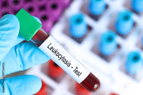 Leukocytosis test, blood sample to analyze in the laboratory photo