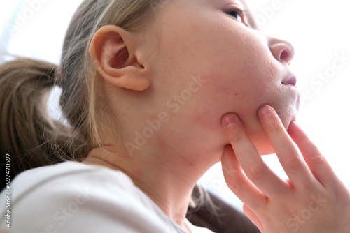 The child scratches atopic skin. Dermatitis, diathesis, allergy on the child's face.