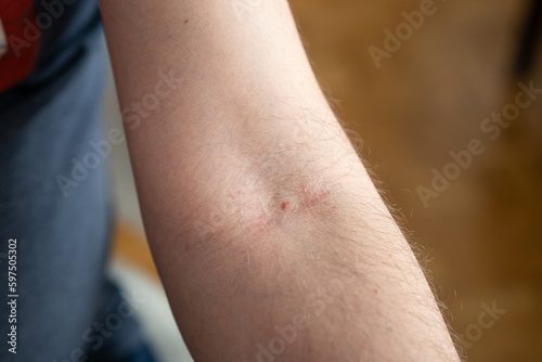 Foto Small mark left by the needle on the elbow pit of a Caucasian male arm