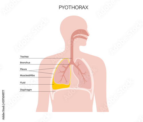 Pyothorax pleural empyema