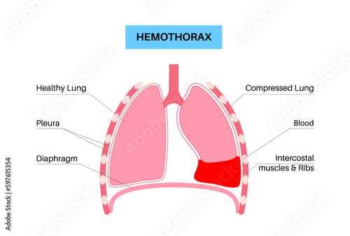 Hemothorax medical poster