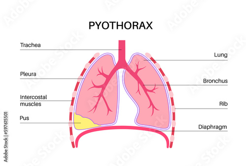 Pyothorax pleural empyema