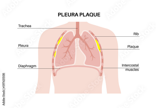 Pleural plaque poster