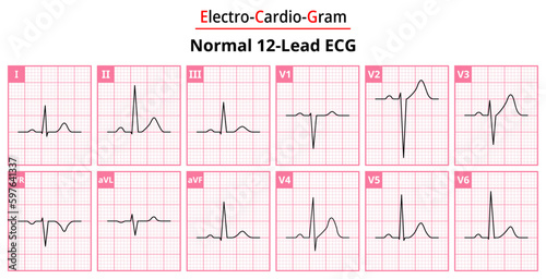 The Differences in Normal ECG Waveform for Each of the 12 Leads Standard ECG - Medical Vectors and Illustrations for Medical Purposes