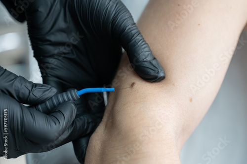 Dermatologist removes a mole on a patient s arm using an electrocoagulator. 