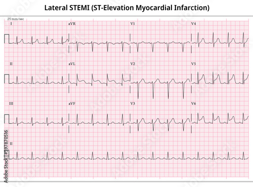 Lateral ST-Elevation Myocardial Infarction (STEMI) - 12 Lead ECG Common Case - 3 Sec/lead - Vectors and Illustration for Medical Purposes